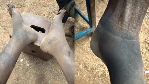 Rishab Shetty Reveals Painful Shooting Struggles For Kantara Chapter 1 Leg Injury Photos Go Viral Rishab Shetty Reveals Painful Shooting Struggles For Kantara Chapter 1 Leg Injury Photos Go Viral