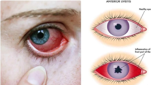 Summer Eye Allergies and Dry Eyes