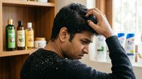 നിങ്ങളുടെ തലയിൽ താരനുണ്ടോ? എങ്കിൽ ഈ 5 എണ്ണകൾ മറന്നേക്കൂ, തലയിൽ തേച്ചാൽ എട്ടിന്റെ പണി കിട്ടും