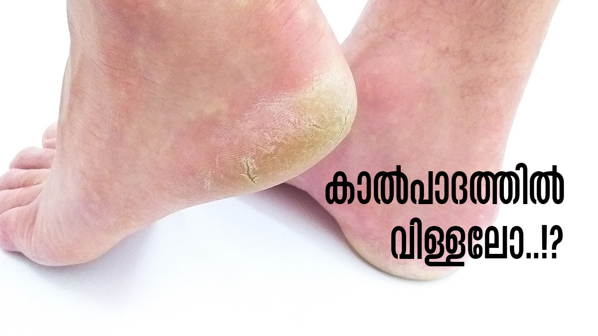 പാദങ്ങള്‍ വിണ്ടുകീറുന്നോ..? പേടിക്കേണ്ട, വീട്ടിലുണ്ടല്ലോ ഉറപ്പായും ഫലം തരുന്ന പരിഹാരം