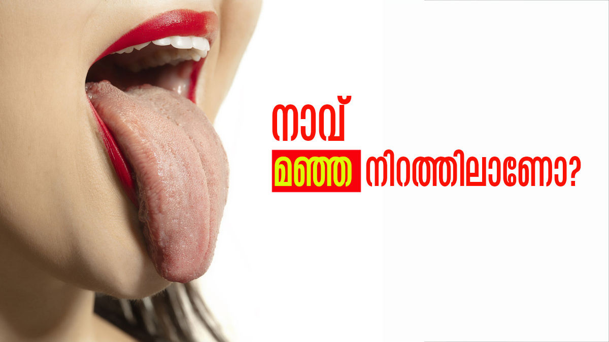 വൃത്തിയാക്കിയിട്ടും നിങ്ങളുടെ നാക്ക് മഞ്ഞനിറത്തിലാണോ..? ഇതായിരിക്കാം കാരണം, ശ്രദ്ധിക്കണം