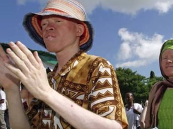 ആല്‍ബിനോകള്‍