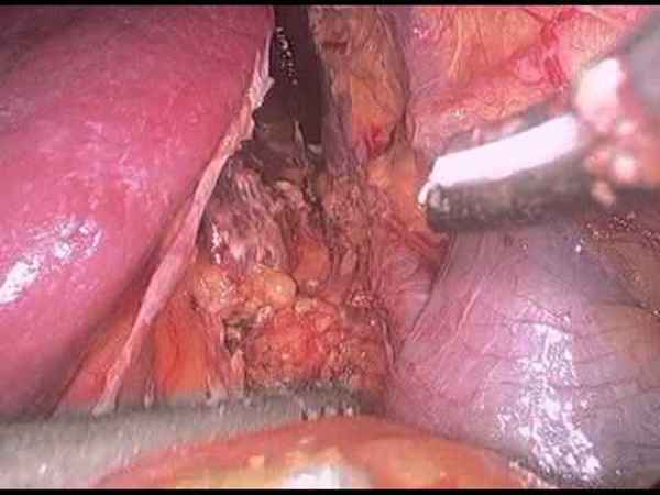 വലയിലാക്കിയത്