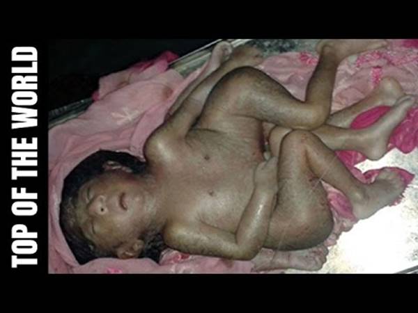 പോളിമീലിയ