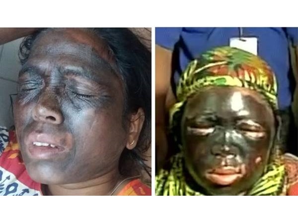 കാഴ്ചശക്തി നഷ്ടപ്പെട്ടേക്കാം