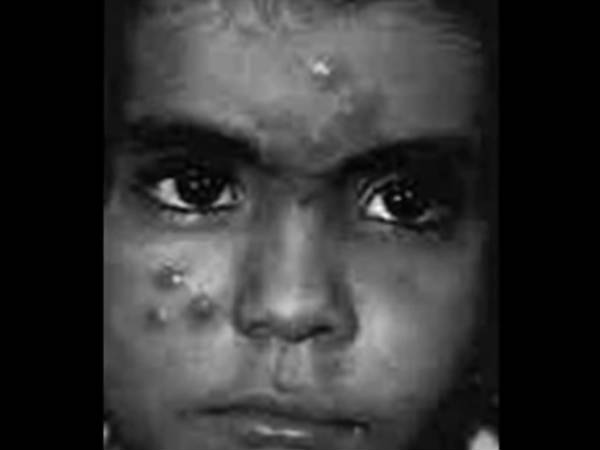 ഇങ്ങനെയാണ് രോഗം