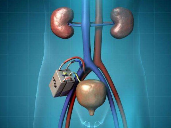 ഡയാലിസിനേക്കാള്‍ ഗുണം ചെയ്യും
