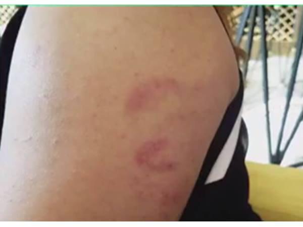 മര്ദനമേറ്റ പാട് മര്ദനമേറ്റ പാട്