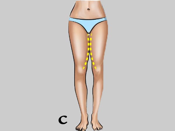 പരസ്പരം മുട്ടുന്ന തുടകള്‍