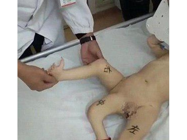 മൂന്നാം കാല്‍വന്നത് ഇങ്ങനെ