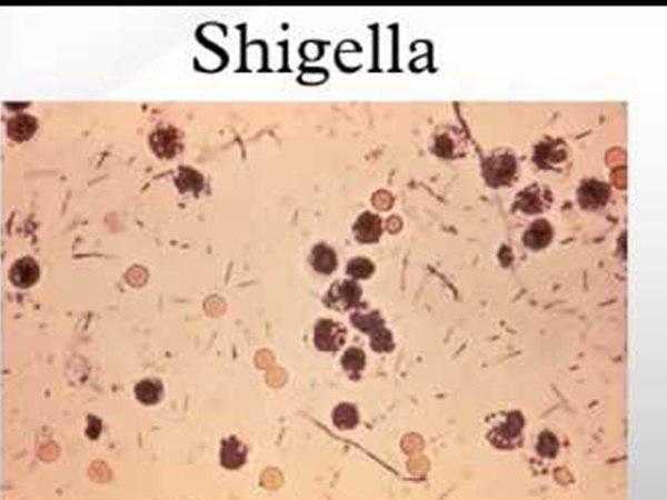 ലക്ഷണങ്ങൾ