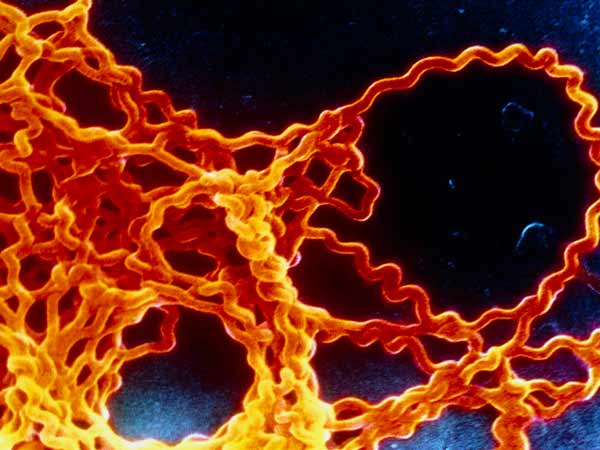 എലിപ്പനിയുടെ ലക്ഷണങ്ങൾ