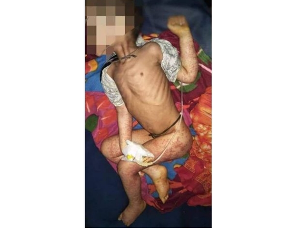 അപസ്മാരം