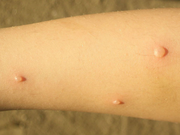 ചിക്കൻപോക്‌സ് എന്നാൽ...