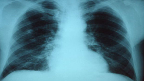 60000 എക്‌സറേ