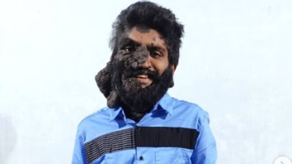 പ്രഭുലാലിൻറെ വലത് തോൾഭാഗത്ത് മുഴ 