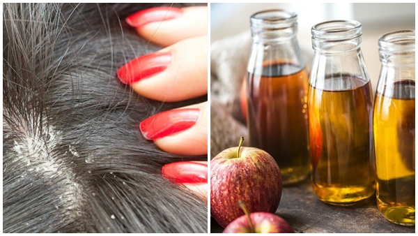apple cider vinegar for dandruff
