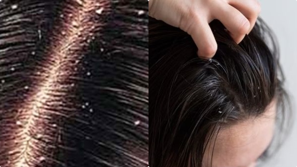 anti-dandruff-tips