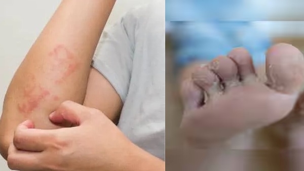 skin infection