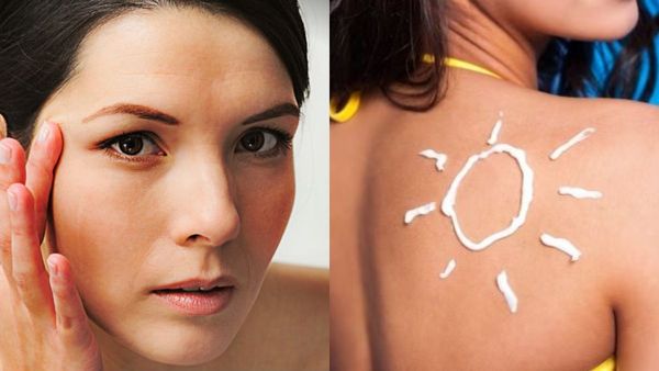 sunburn remedies sunburn remedies