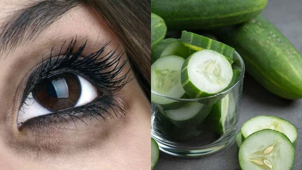 under eye dark circles