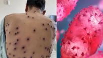 Mpox Outbreak: एम्सकडून मंकीपॉक्स संदर्भात आरोग्यविषयक अलर्ट जारी