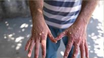 आफ्रिकन देशांमध्ये Mpox विषाणूचा उद्रेक, WHO चा इशारा- ओरल सेक्स, चुंबन थुंकीनेही पसरतो व्हायरस