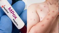 भारतात आढळला Mpox चा नवीन प्रकार स्ट्रेन, जाणून घ्या किती धोकायक आहे क्लेड 1 प्रकार आणि लक्षणे