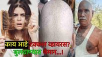 बुलढाण्यात आलाय 'टक्कल व्हायरस'?, कशामुळे होती केस गळती, जाणून घ्या-त्यामागील प्रमुख कारणं! 