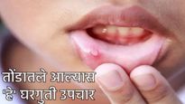 Mouth Ulcers तोंडातले आलेय! हे प्रभावी 10 घरगुती उपचार; जाणून घ्या अल्सरसंदर्भात  काय घ्यावी खबरदारी