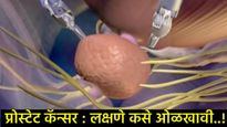 Health Tips : 'या' लक्षणांकडे चुकूनही दुर्लक्ष करू नका, प्रोस्टेट कर्करोगाची असू शकतात ही चिन्हे! 