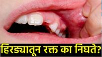 हिरड्यांमधून रक्त येणे अन् तोंडाची दुर्गंधी येतेय का? मग करा हे नैसर्गिक उपचार, जाणून घ्या सविस्तर! 