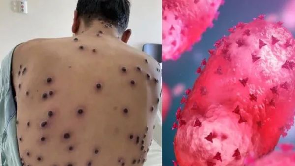 Mpox Outbreak: एम्सकडून मंकीपॉक्स संदर्भात आरोग्यविषयक अलर्ट जारी