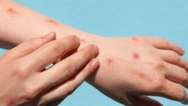 सावधान..भारतात मंकीपॉक्सची एंट्री?,विदेशातून आलेल्या व्यक्तीस केले क्वॉरंटाईन