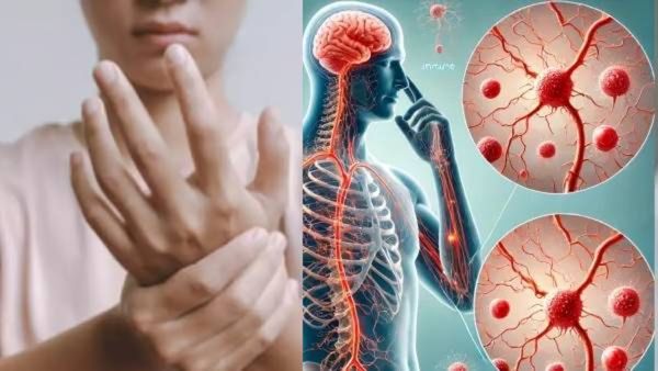 पुण्यात GBS आजाराचे थैमान; दोघांचा मृत्यू! रुग्ण संख्या शंभरीपार, उपचारास खर्च किती, जाणून घ्या सर्व