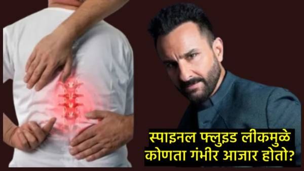 सैफच्या मणक्यावर चाकूने वार झाल्याने त्याचा स्पाइनल फ्लुइड लीक, ही स्थिती किती धोकादायक?, जाणून घ्या