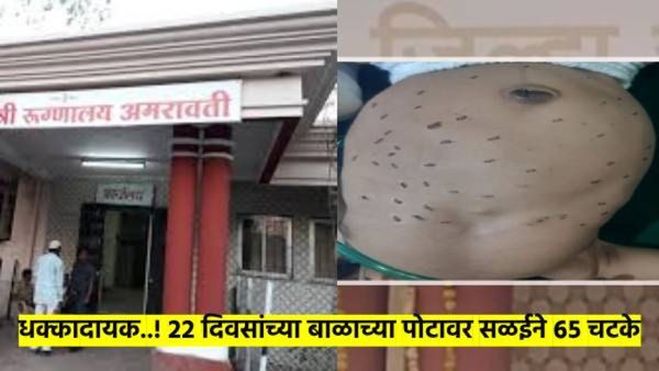 धक्कादायक! २२ दिवसांच्या बाळाला दिले ६५ चटके; 'त्या' गावात अंधश्रद्धेतून केला भयानक प्रकार