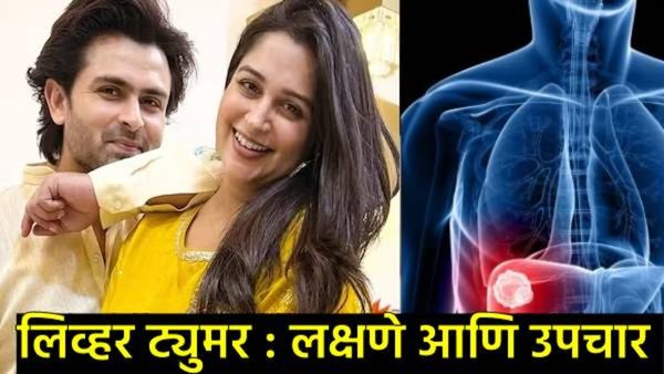 लिव्हर ट्यूमरचा सामना करतेय दीपिका कक्कर; 'या' आजाराचे काय आहेत कारणं अन् कशी असतात लक्षणे?