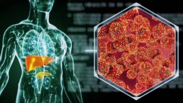 ना कधी नशा, ना दारू पिली तरीही यकृत खराब: चुकीच्या जीवनशैलीमुळे 29 वर्षीय तरुणीला गंभीर आजार!