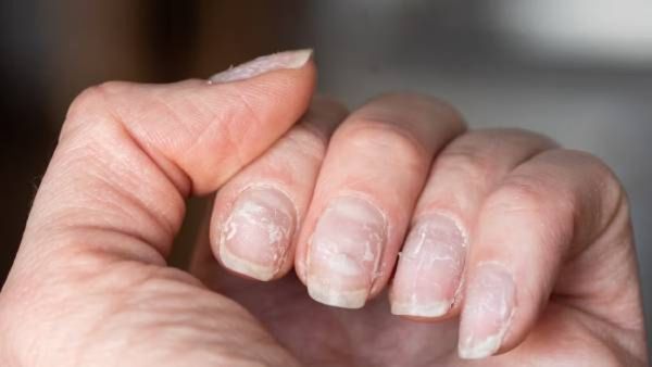 तुमच्या नखांचा रंग बदलतोय काय, मग या बीमारीचे आहे संकेत; वेळीच जाणून घ्या अन् सतर्क व्हा!