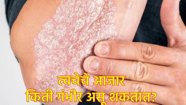 त्वचारोग आता गंभीर आजार: WHOने घेतला मोठा निर्णय, Essential Medicines List मध्ये 'या' औषधांचा समावेश