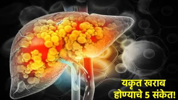 Liver Damage Signs : यकृत निकामी होण्यापूर्वी शरीर देतं 'हे' 5 संकेत; दुर्लक्ष करणं पडू शकतं महागात