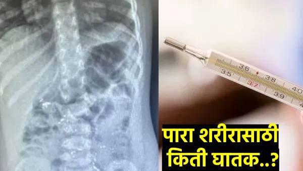 Thermometer exploded boy s mouth doctors saved his life