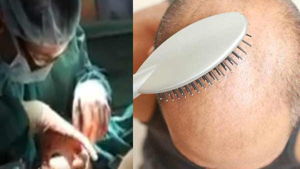 Hair transplant incident Hair transplant incident