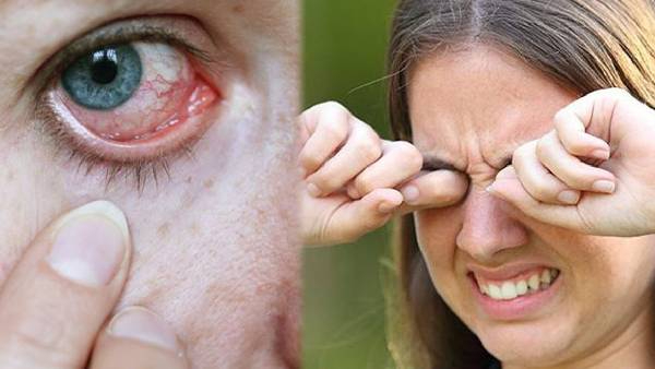 WHO declares India Trachoma free WHO declares India Trachoma free