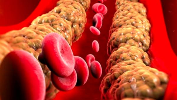 high cholesterol symptoms