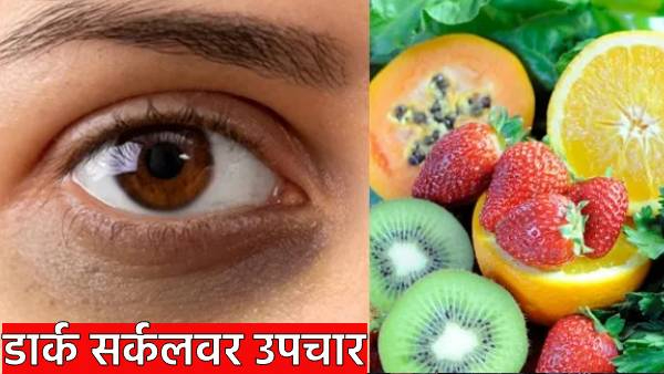 Eyes Dark circles Expert treatment tips