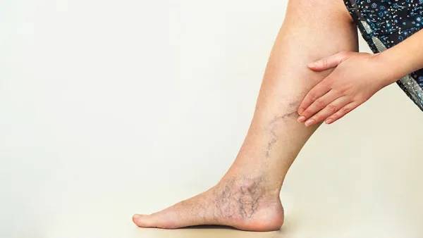 DVT in Pregnancy Leg Swelling and Pain Causes DVT in Pregnancy Leg Swelling and Pain Causes