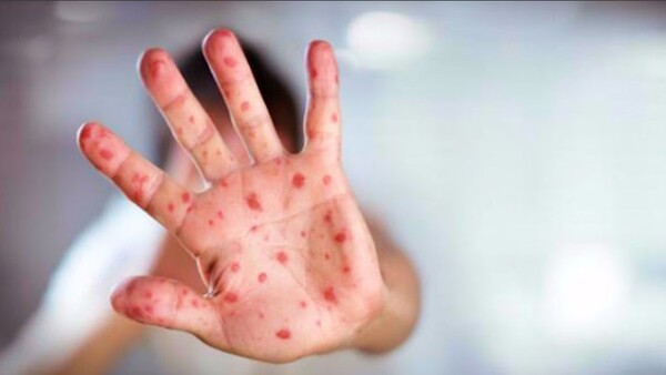 measles measles