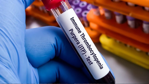 Immune Thrombocytopenic
